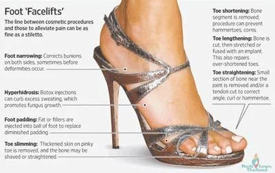 Weibliche Füsse in High Heels — Sinnbild für den fragwürdigen Trend der Fuss-Schönheitschirurgie