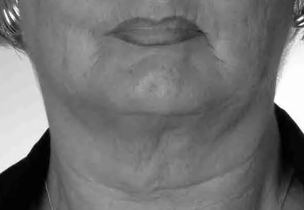 Gesicht vorher und nachher Gesichtsmuskeltraining mit der FACE-Methode®